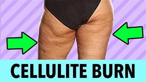 Day Cellulite Burn Challenge Get Rid Of Cellulite On Thighs And