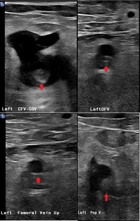 Cureus Deep Venous Thrombosis In A 62 Year Old Female With