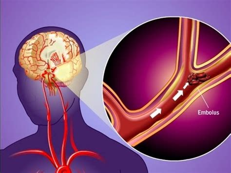 Transient Ischemic Attack Tia