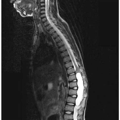 Mri Spine T2w1 Showing Hyperintense Cystic Lesion Is Seen Extending