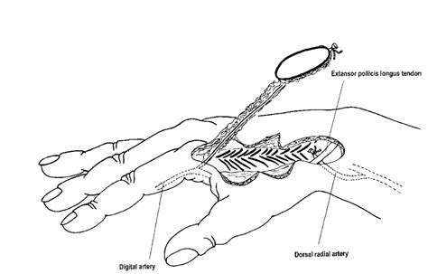 Reverse Flow First Dorsal Metacarpal Artery Flap For Index Fingertip