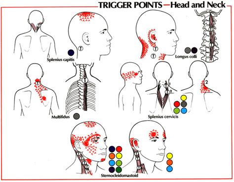 Understanding Myofascial Trigger Points And Referred Pain Patterns