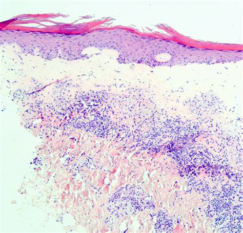 Lichen Sclerosis Histology