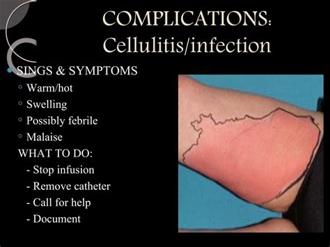 Ppt Intravenous Peripheral Cannulation Powerpoint Presentation Free