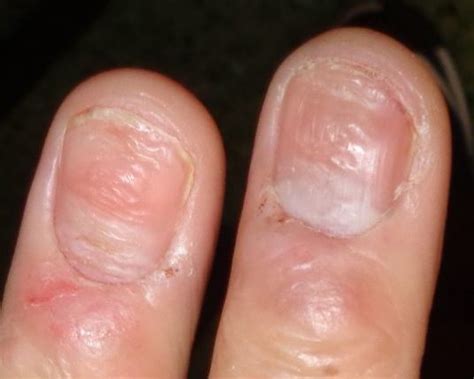 Derm Dx Disfiguration Of Finger And Toe Nails Clinical Advisor