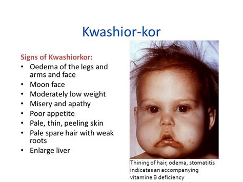 Σύνδρομο Kwashiorkor Emedigr Πρόληψη Υγείας