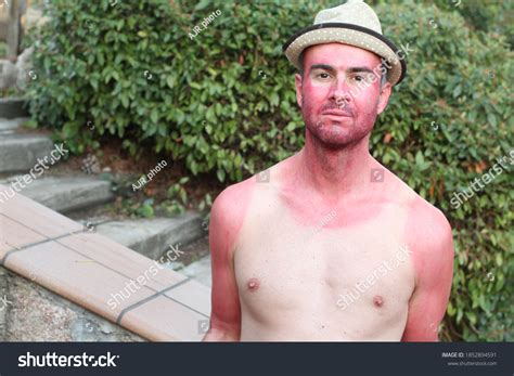 Sunburnt Man Over 1704 Royalty Free Licensable Stock Photos