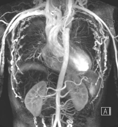 Aortic Coarctation With Extensive Collateral Circulation Circulation