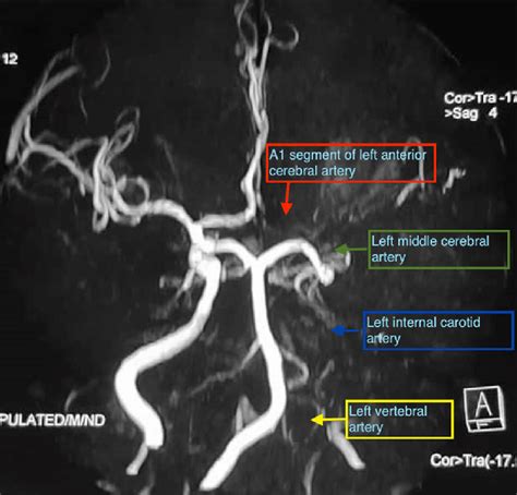 Mr Angiogram Shows Loss Of Flow Signal In Intracranial Left Internal Download Scientific