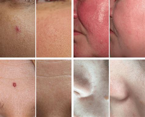 Ipl For Rosacea And Red Veins The Spa Therapy Room Chelmsford