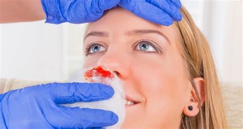 Nosebleed And Facial Injuries Causes And Treatment