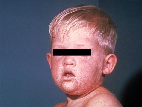 Measles What You Need To Know Mahoney Dermatology