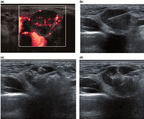 Thyroid Cancer Ultrasound Colors Thyroid Cancer Happens Childrens