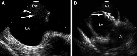 Echocardiographic Assessment Of Percutaneous Patent Foramen Ovale And