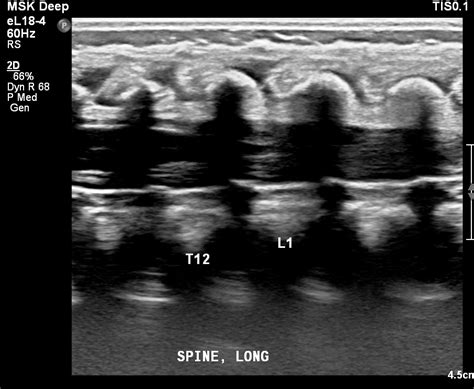 Neonatal Ultrasound Lumbosacral Spine Radiology Template
