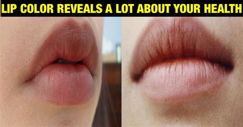 What Does Your Natural Lip Color Say About Your Health Know Here