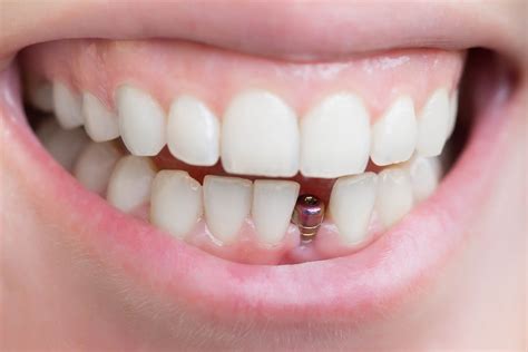 Single Tooth Implant Dental Implants Dentist Cinco Ranch Texas