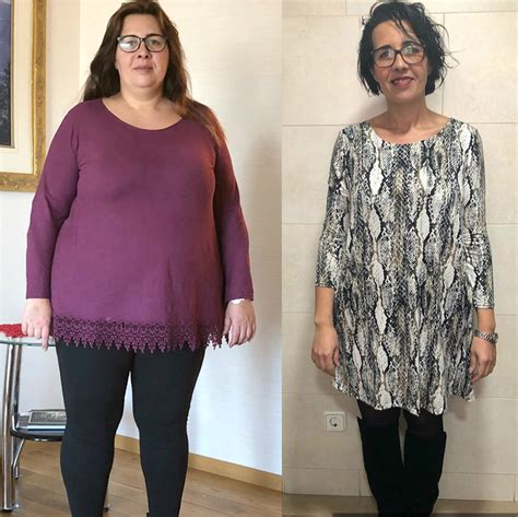 Weight Loss Surgery Before And After Photos Nordbariatric Clinic