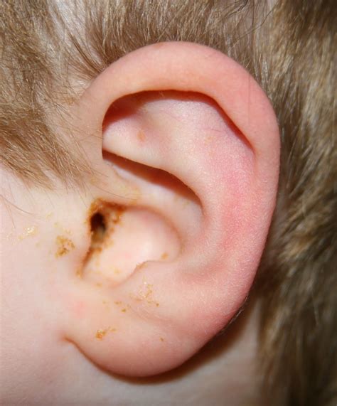 Ear Infection Middle Ear Causes Symptoms Diagnosis And Treatment Natural Health News