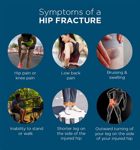 What Are The Signs And Symptoms Of A Hip Fracture A Professor Andrew Dutton