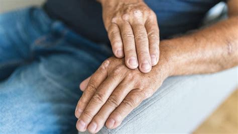 Psoriatic Arthritis Symptoms Causes And Treatments Forbes Health
