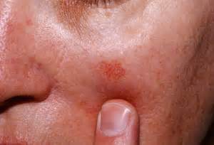 Skin Cancer Nashua Basal Cell Carcinoma New Hampshire Actinic Keratoses