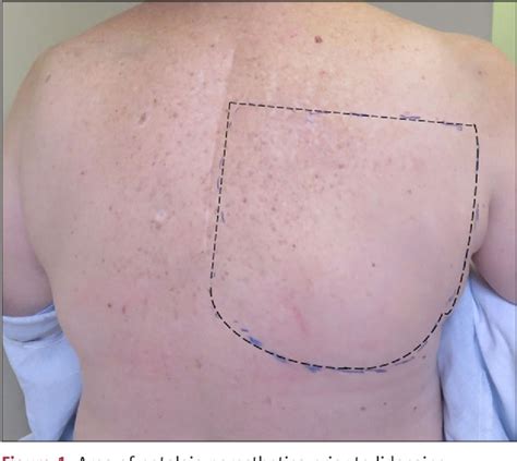 Figure 1 From A Case Report Of Refractory Notalgia Paresthetica Treated