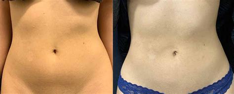 Abs Waist Liposuction Before After Neinstein Plastic Surgery
