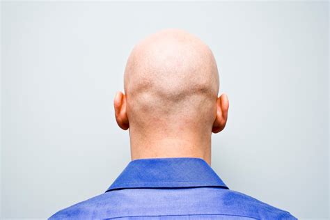 Calling Man ‘bald’ Is Sex Related Harassment Employment Tribunal Rules The Independent