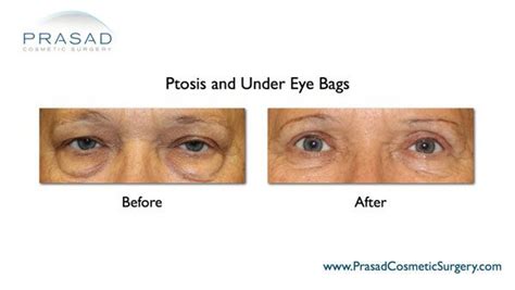 Fortunately we can safely treat them with hyaluronic acid fillers. Eye bag surgery | Lower eyelid surgery | Puffy eyes - NY