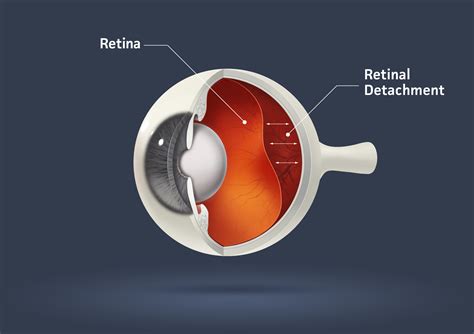The Top Signs You Have Retinal Detachment Drs Campbell Cunningham