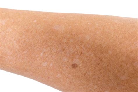 What Are The White Spots On My Skin Waters Edge Dermatology