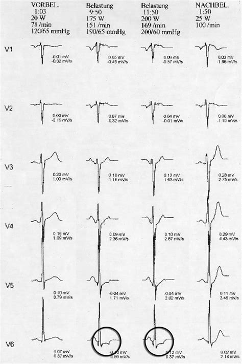 Echo befund vorlage | dem rki wurden gemäß § 6 infektionsschutzgesetz (ifsg) vom 1. Belastungs-EKG