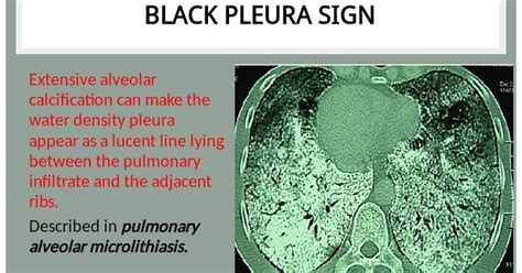 Chest Medicine Made Easy Dr Deepu Black Pleura Sign