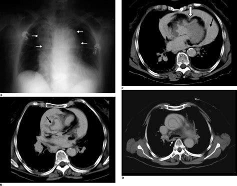 Acute Type A Aortic Dissection And Cardiac Tamponade Journal Of