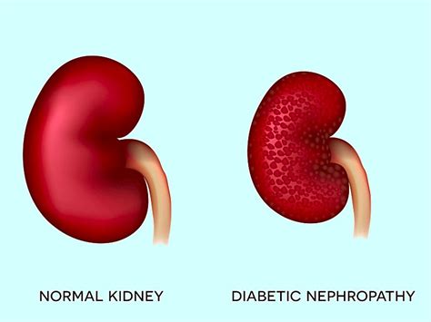 Diabetic Nephropathy Causes Symptoms And Treatment How To Relief