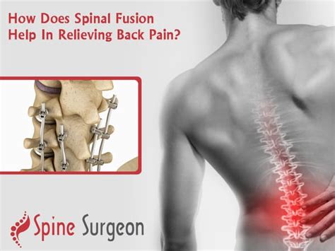 How Does Spinal Fusion Help In Relieving Back Pain Spine Surgeon