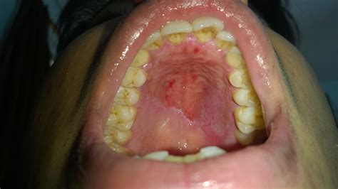 Pain And Swelling On The Roof Of My Mouth 12300 About Roof