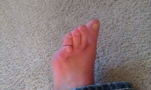 My Toe Deformity