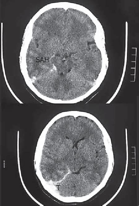 Cerebral Venous Thrombosis With Subarachnoid Hemorrhage A Case Report