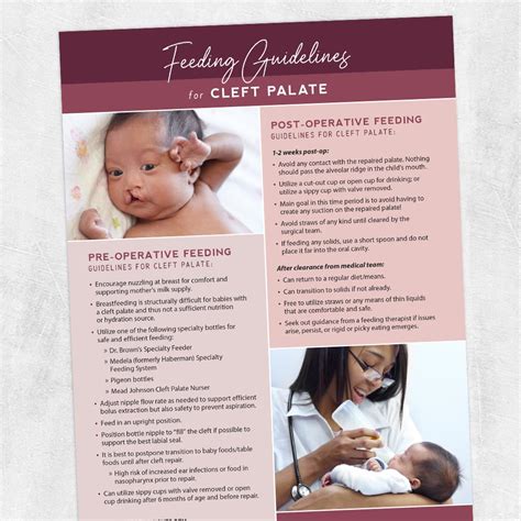 Feeding Guideline For Cleft Palate Pre And Post Repair Adult And Pediatric Printable