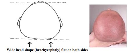 Deformational Plagiocephaly And Brachycephaly Chp