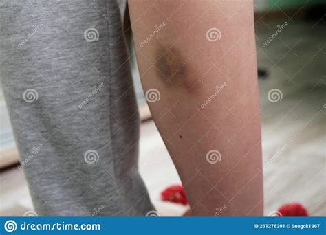 Closeup Of Hands Applying Balm To Leg Knee Injury Skin Hematoma Skin