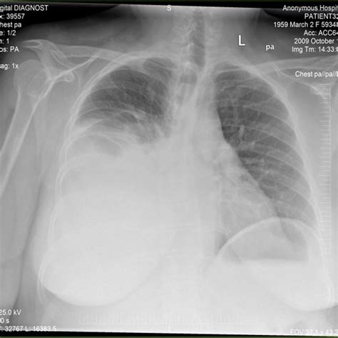 Lateral Cxr Showing Right Sided Pleural Effusion Download Scientific