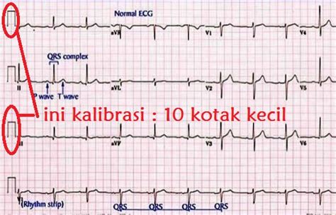 Elektokardiogram adalah suatu grafik yang menggambarkan rekaman listrik jantung. Mengenal Kalibrasi EKG Untuk Ketepatan Interpretasi ...