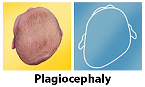 Plagiocephaly My Favourite Physio