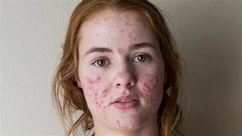 This Girls Before And After Acne Selfies Are Going Viral For An