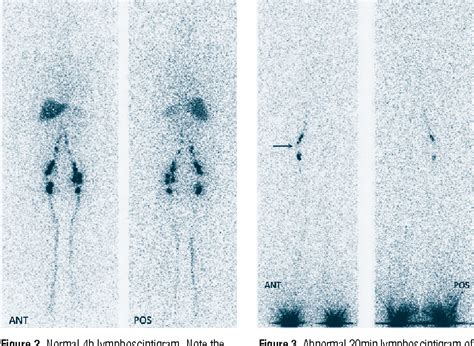 Figure 3 From Diagnostic Application Of Lymphoscintigraphy In The