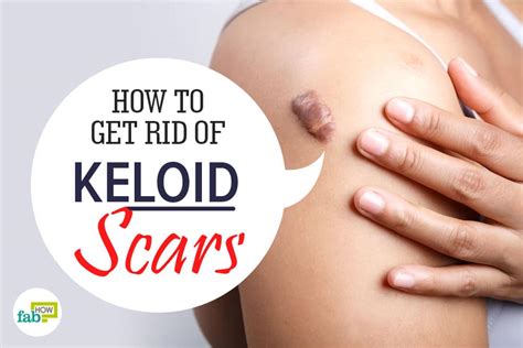 Get insights on how to get rid of scars on face from scratches, burns, pimples, acne, fast using natural ingredients. How to Get Rid of Keloid Scars: 4 Easy Remedies | Fab How