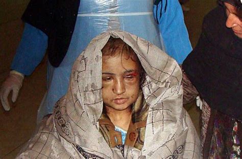 Afghanistan La Sposa Bambina Torturata Dal Marito Diventa